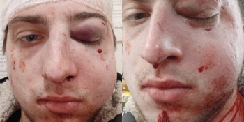 Множинні переломи кісток обличчя: журналіста OBOZREVATEL жорстоко побили в Києві