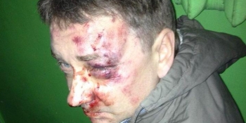 «Безкарність убиває!» – Сергій Томіленко про справу побитого журналіста Євгена Положія