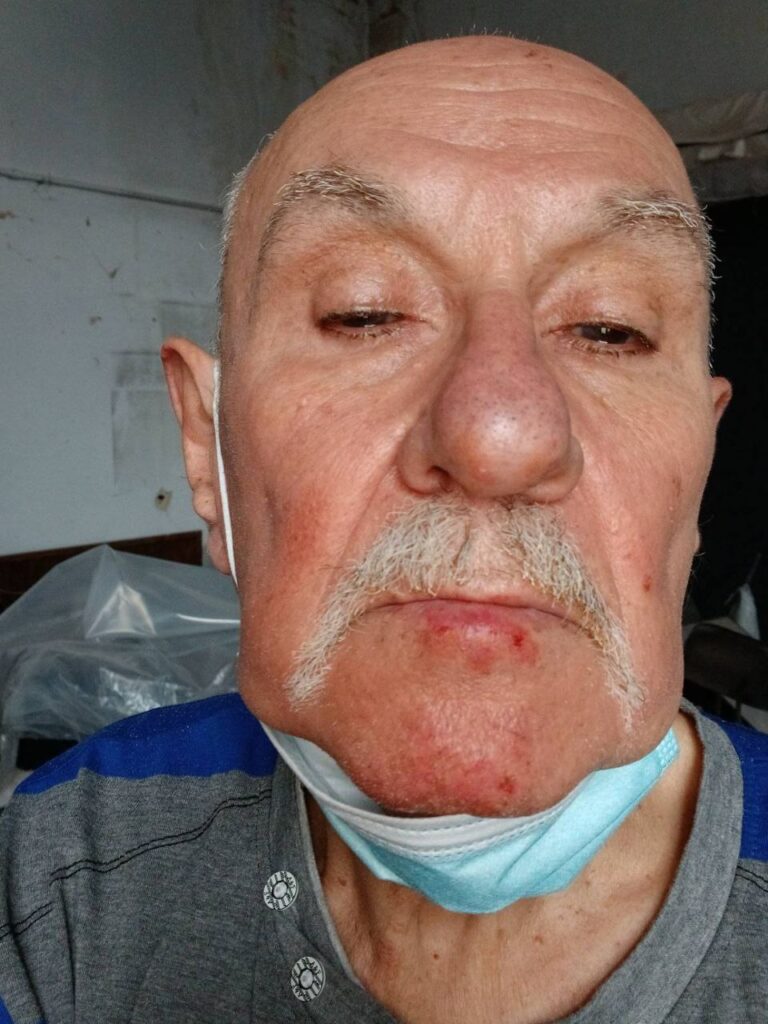 Унаслідок ворожої атаки по Дніпру постраждав фотокор Микола Кошелев 3